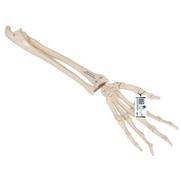 Hand met ulna & radius