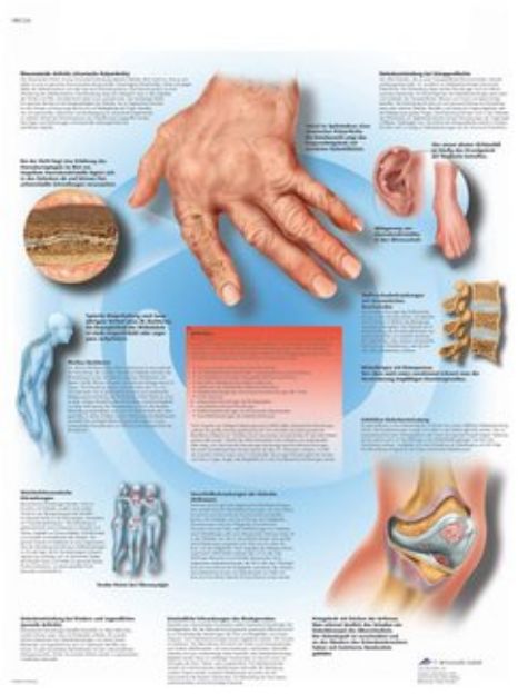 Afbeeldingen van Rheuma